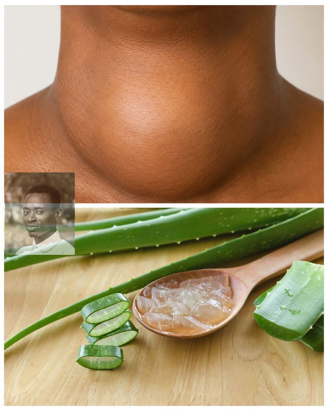 Traditional Aloe Vera Remedy for Goiter: What You Should Know